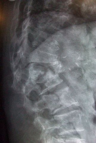 vertebral fracture