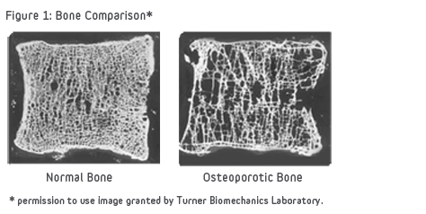 Bone Comparison of Healthy and Osteoporotic Vertibrae
