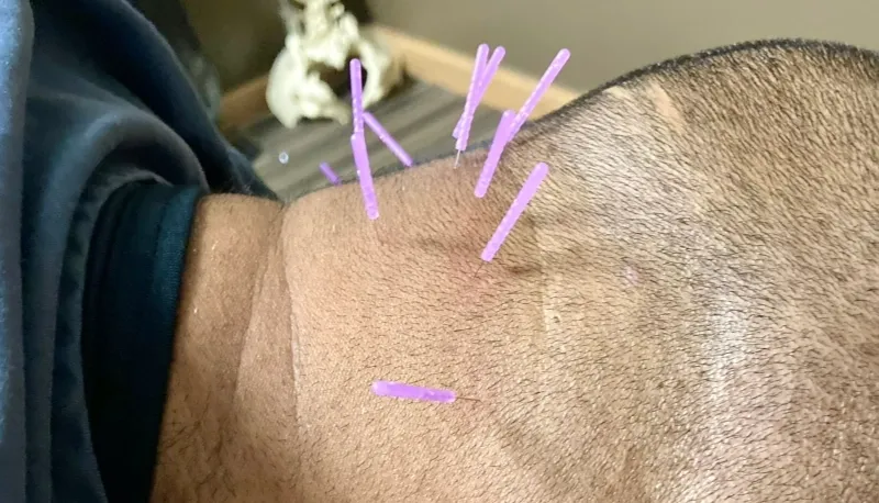 man gets dry needling on back of head