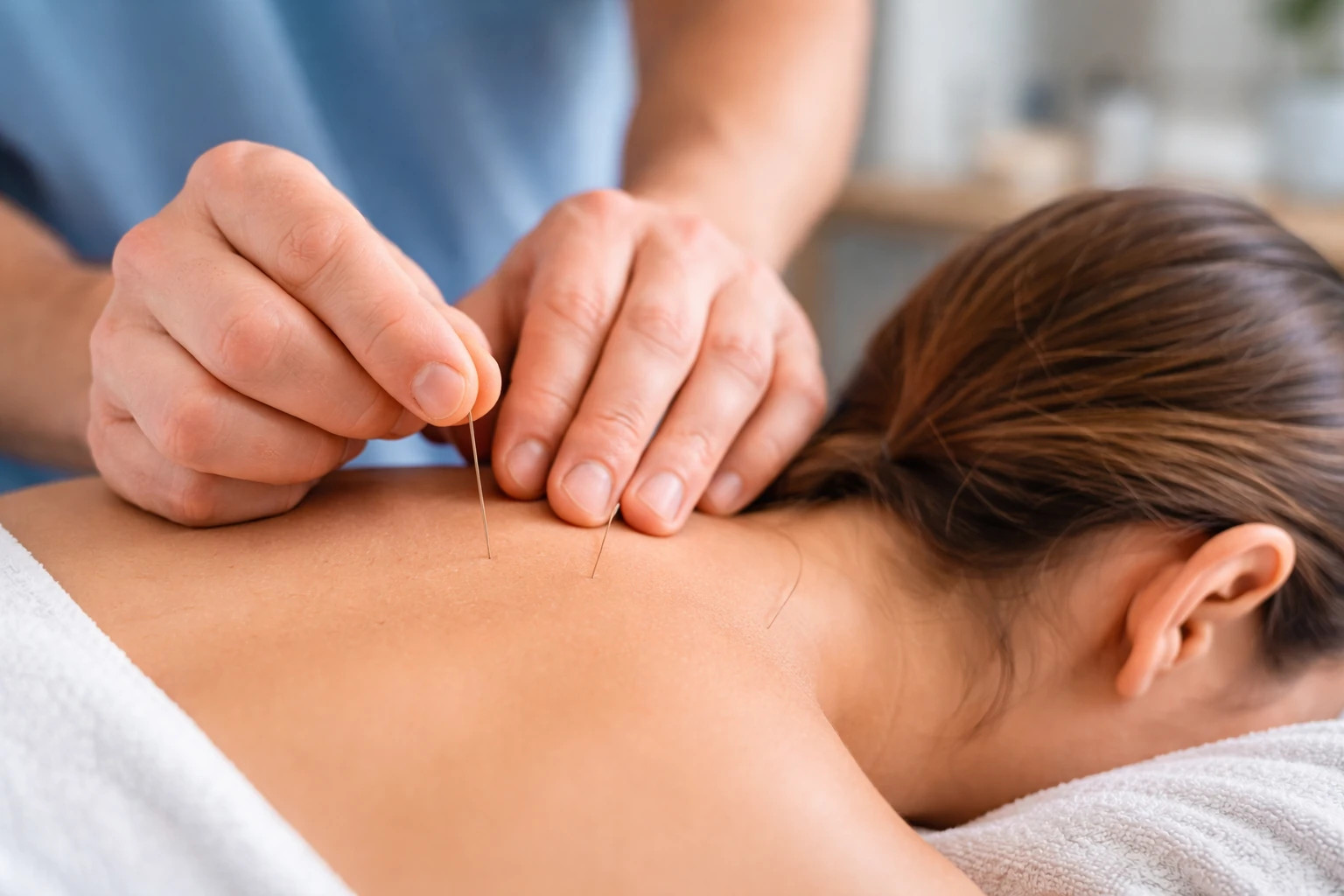 Dry Needling vs Acupuncture (and Massage): What It’s Good For in 2026 — Everett, WA Guide