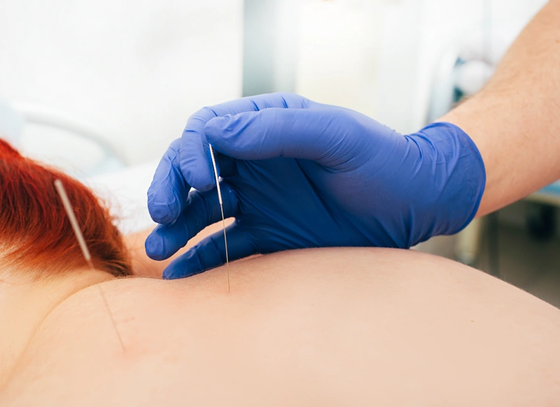 dry needling done on the back