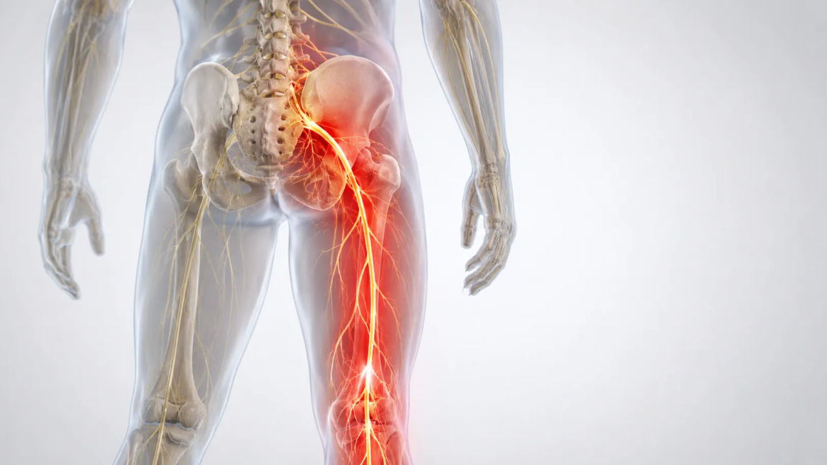 When Sciatica Starts Affecting Walking, Sitting, or Sleep: When to Get Checked in Everett, WA