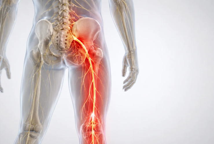 Anatomical illustration showing sciatic nerve pain radiating from the lower spine through the buttock and down the leg