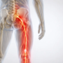 When Sciatica Starts Affecting Walking, Sitting, or Sleep: When to Get Checked in Everett, WA