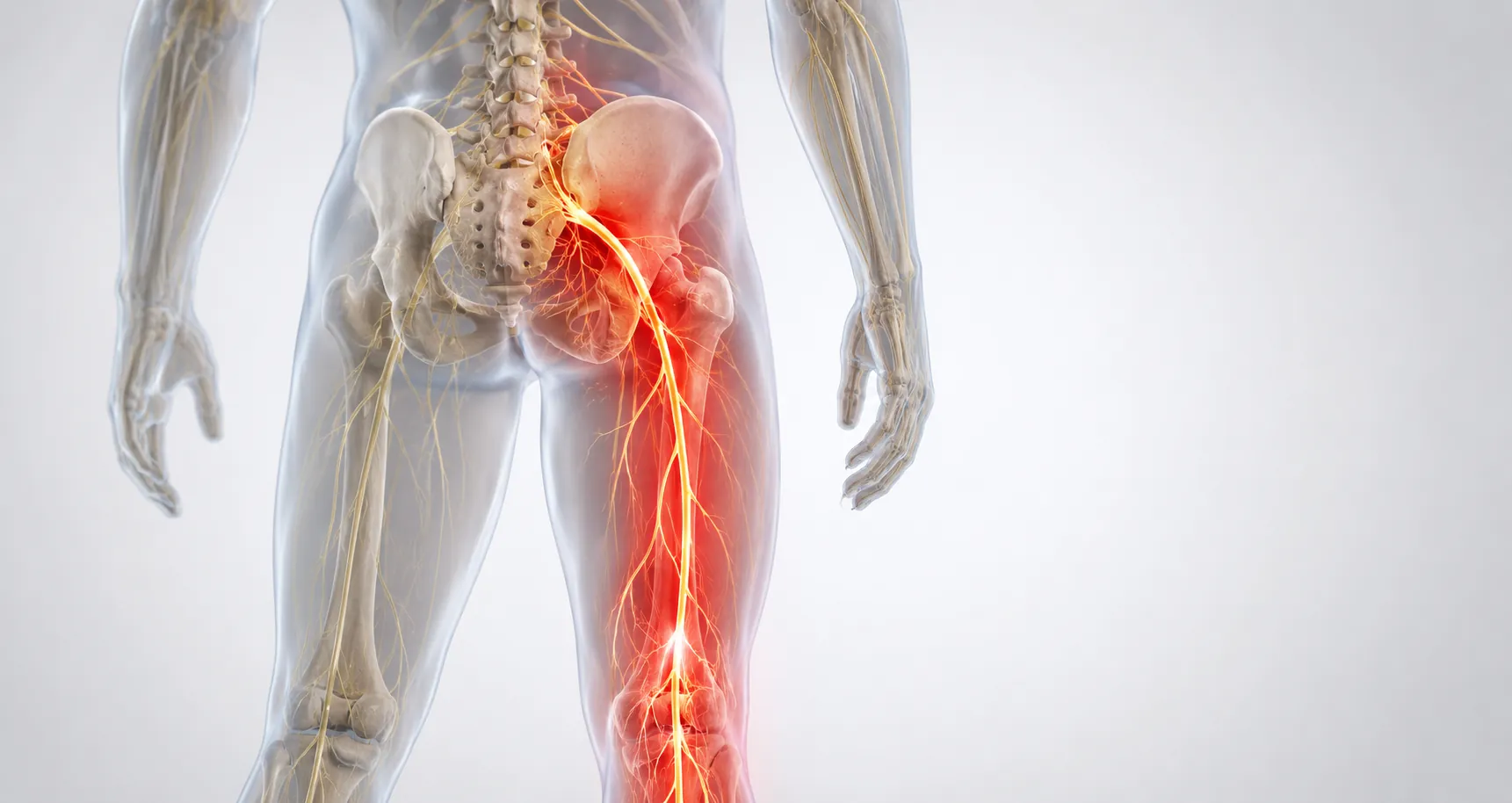 Anatomical illustration showing sciatic nerve pain radiating from the lower spine through the buttock and down the leg