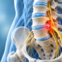 What Is a Slipped Disc or Herniated Disc, Exactly?